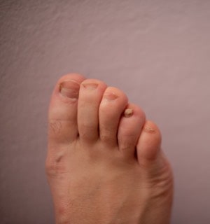 feet fungus